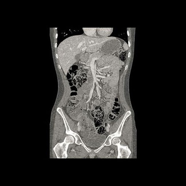 GE Healthcare Revolution Discovery CT