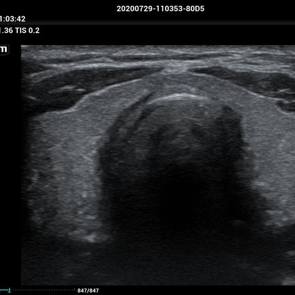 Mindray MX7