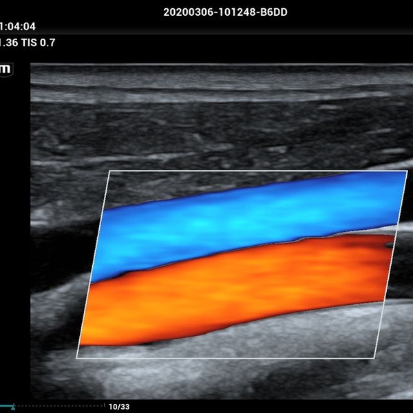 Mindray MX7