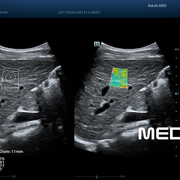 Mindray DC-80 Exp